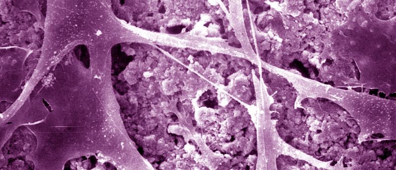 Colorized scanning electron micrograph shows bone cells attaching to a new type of bone cement made of calcium phosphate.