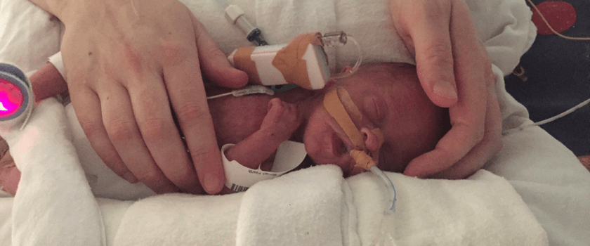 Photo of a premature baby in a hospital