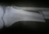 Stem cell-coated biomaterial speeds up fracture repair