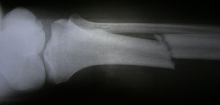 Stem cell-coated biomaterial speeds up fracture repair
